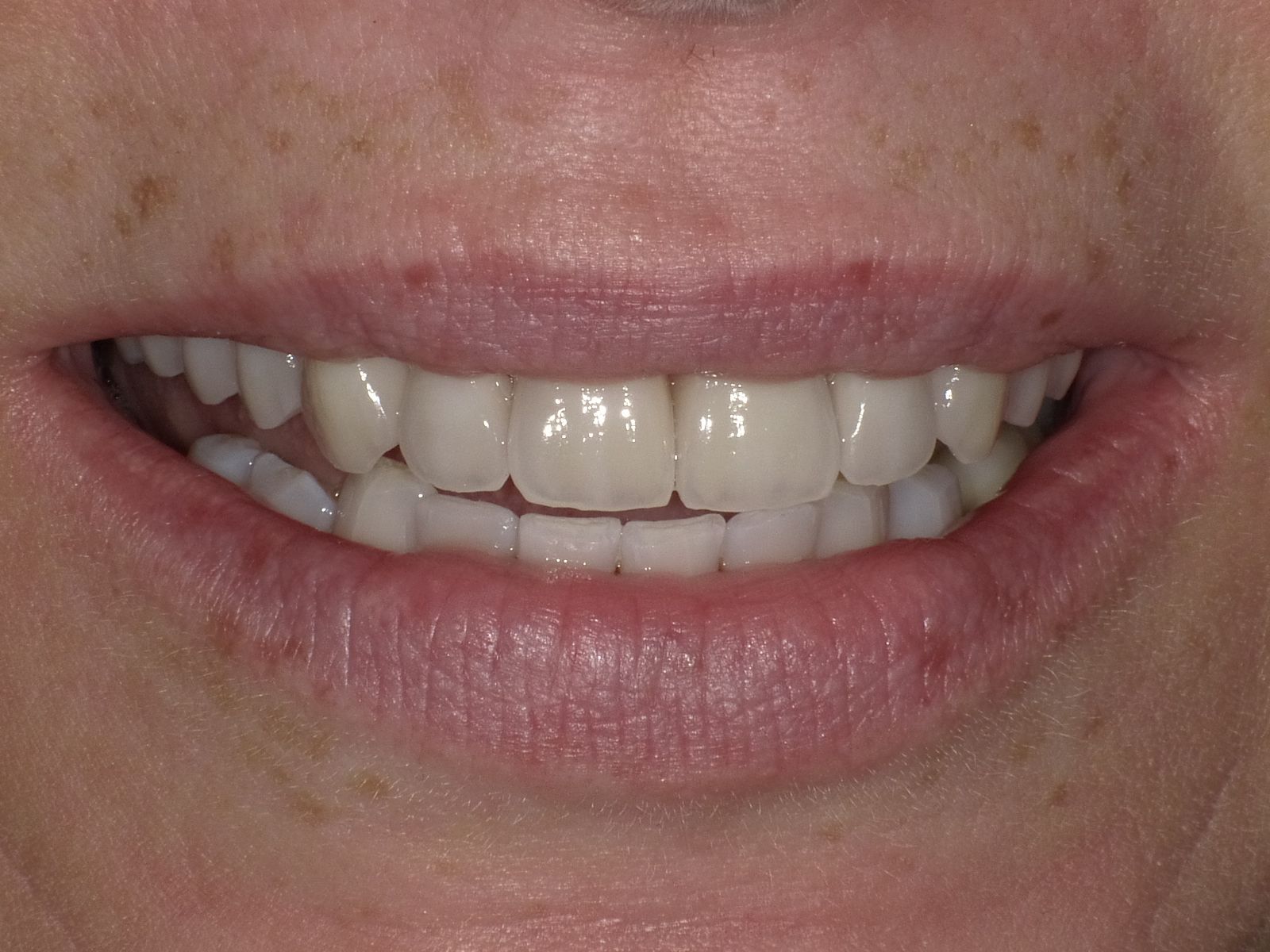 Korrektur des gesamten Oberkiefers mit vollkeramischen Veneers und Kronen in nur 2 Terminen; Unterkiefer: Bleaching